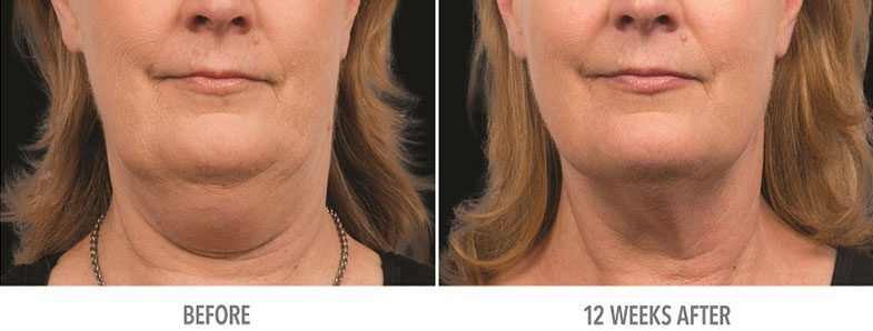 Non-Surgical Fat Reduction Treatment, fat freezing